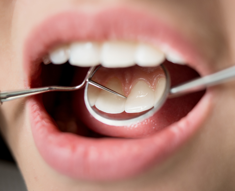 Periodontoloji (Diş Eti Hastalıkları Tedavisi)